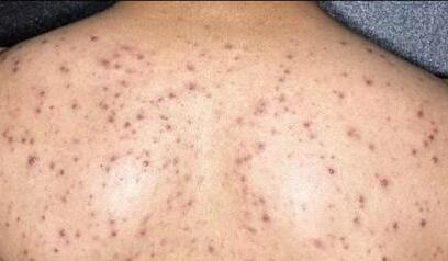 背部长痘怎么办严打背部暗疮有五招！