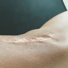 受伤了怕留疤该做些什么,如何处理刀疤不留疤痕