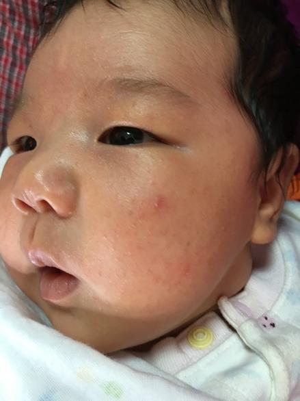 湿疹痱子都有的婴儿该怎么办,宝宝湿疹痱子用什么药膏