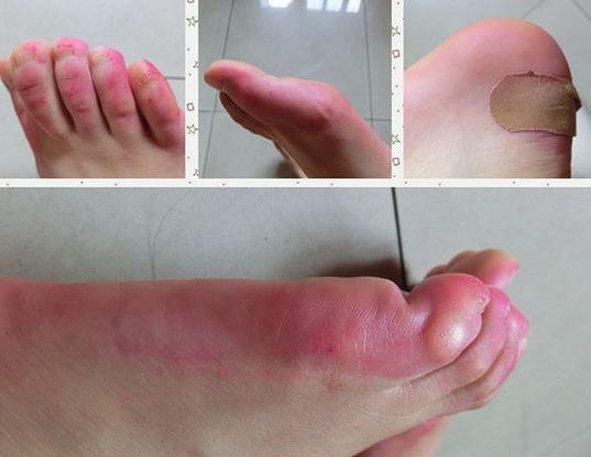 皮鞋磨脚趾头的小妙招,生活小妙招皮鞋凹陷怎么恢复