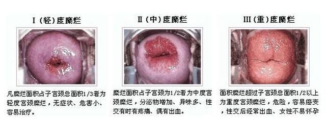 宫颈糜烂重度备孕有影响吗,重度宫颈糜烂宫颈息肉怀孕了