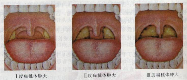 小儿高烧40度，我用“蛋滚疗法”半小时退烧，宝爸宝妈快快收藏