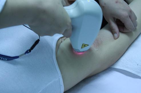 激光脱毛毛发比较旺盛要脱几次,激光脱毛要几次才能干净