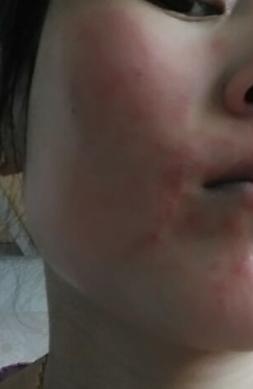 油敏感肌与干敏感肌的区别,不敏感皮可以用敏感护肤品吗