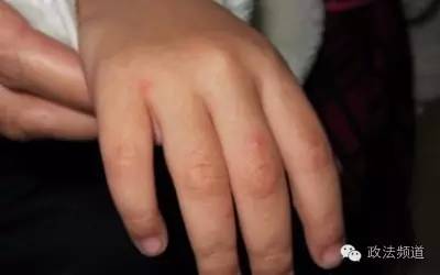 长沙手足口病进入高发期,幼儿园有确诊的手足口病会停课吗