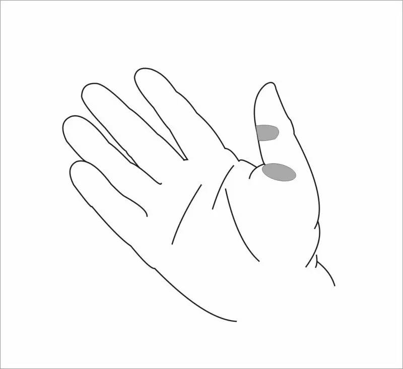 “哪有好医生？”之为什么人人都会得的腱鞘炎，治不好？