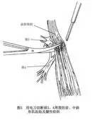 “哪有好医生？”之为什么人人都会得的腱鞘炎，治不好？