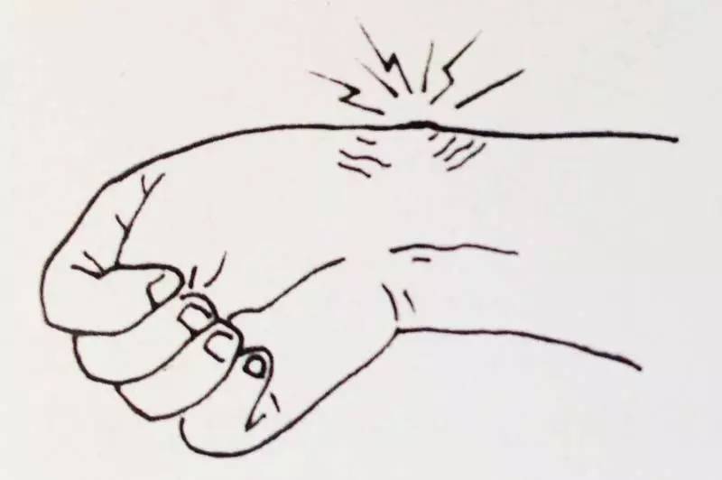 “哪有好医生？”之为什么人人都会得的腱鞘炎，治不好？