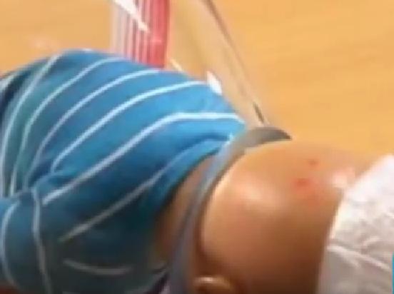 谁会想到，分娩辅助器点子，来自空瓶取软木塞