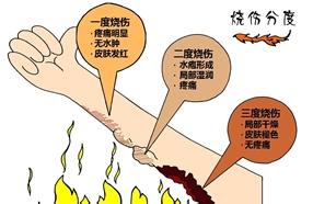 烧伤后如有水泡应及时刺破,被烧伤怎么治疗恢复