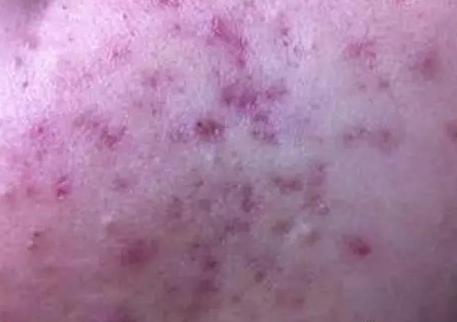 痘痘发炎红肿多久能消退,痘痘发炎红肿怎么办要割掉吗