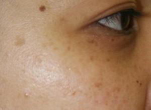 养成美白的好习惯,养成好习惯远离白癜风