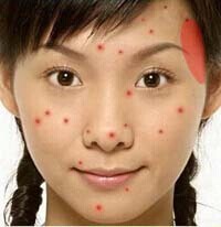 痘痘是身体什么地方出了问题,痘痘告诉你哪里生病了