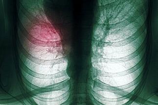 肺癌个体化治疗,谈肺癌的规范化治疗