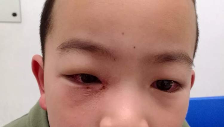 小孩眼红流泪有眼屎用什么滴眼液,孩子眼红有眼屎眼睛痒怎么办
