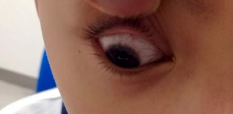 小孩眼红流泪有眼屎用什么滴眼液,孩子眼红有眼屎眼睛痒怎么办