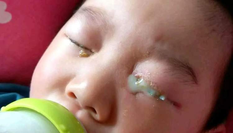 小孩眼红流泪有眼屎用什么滴眼液,孩子眼红有眼屎眼睛痒怎么办