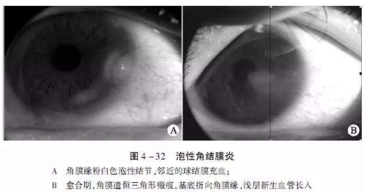 小孩眼红流泪有眼屎用什么滴眼液,孩子眼红有眼屎眼睛痒怎么办