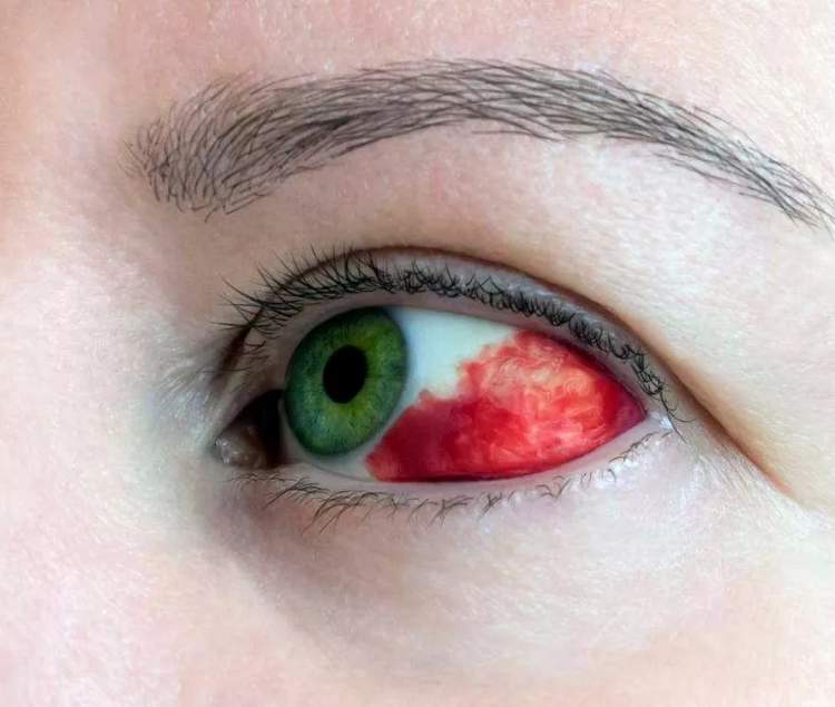 小孩眼红流泪有眼屎用什么滴眼液,孩子眼红有眼屎眼睛痒怎么办