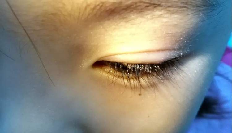 小孩眼红流泪有眼屎用什么滴眼液,孩子眼红有眼屎眼睛痒怎么办