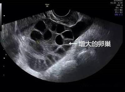 女大学生卖卵20颗赚3.5万最后住院这是违法买卖