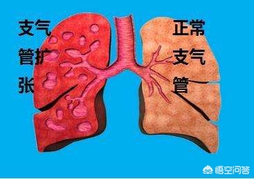支气管扩张能彻底治好么,支气管扩张能彻底治好吗