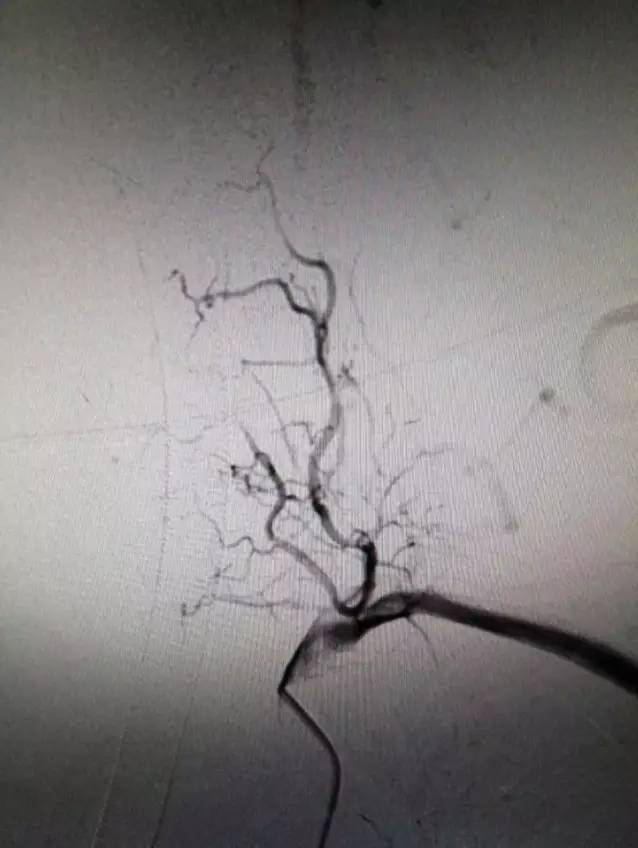 市人民医院取栓手术的全过程,病例分享视频素材