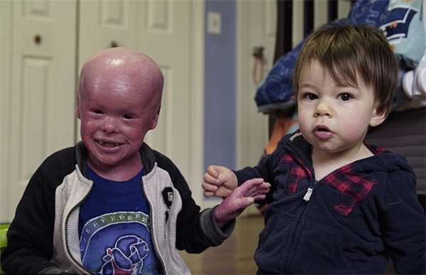 小儿子鱼鳞皮肤,小男孩出生就患皮肤病