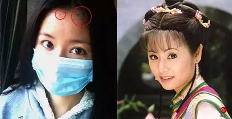 明明不是很油为什么长痘,下巴额头长痘是属于痘痘肌吗