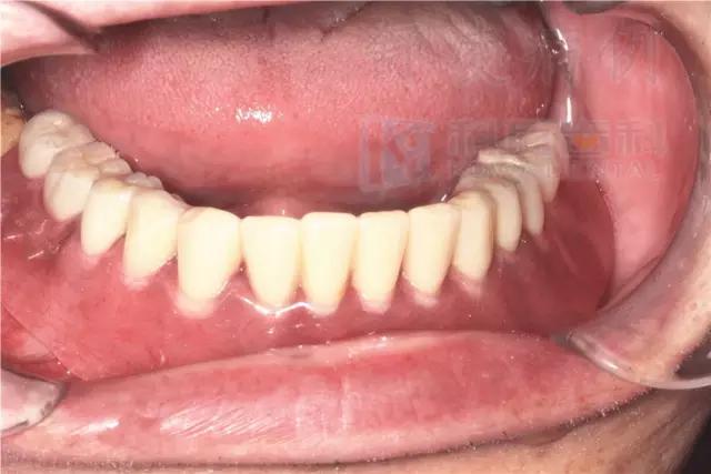 活动假牙戴不住，种植牙又嫌贵该怎么办？