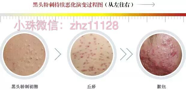 白头粉刺和炎症丘疹的区别,粉刺结节的最佳治疗方法