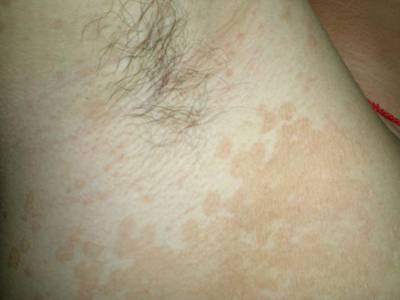 治汗斑有什么土方法,汗斑可以彻底治好吗