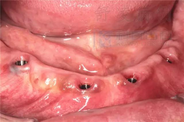 活动假牙戴不住，种植牙又嫌贵该怎么办？