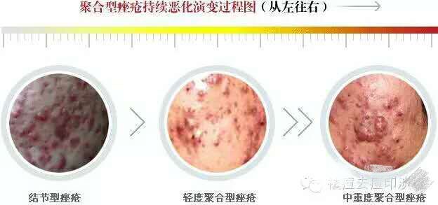 白头粉刺和炎症丘疹的区别,粉刺结节的最佳治疗方法