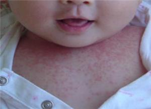 10个治痱子的小偏方,有什么偏方治疗痱子一样的湿疹