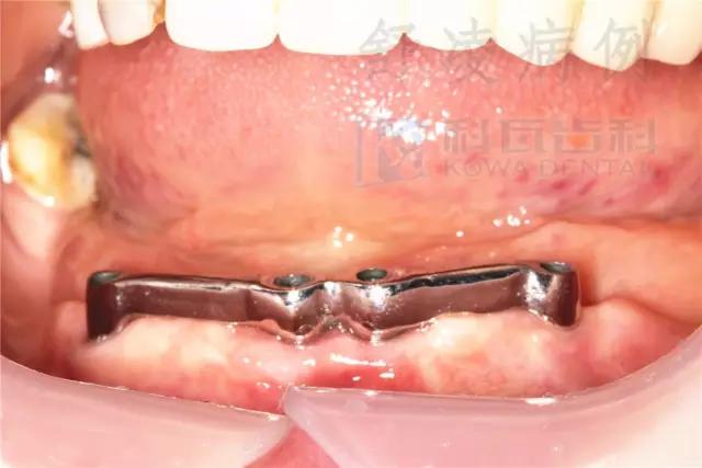 活动假牙戴不住，种植牙又嫌贵该怎么办？