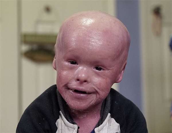 小儿子鱼鳞皮肤,小男孩出生就患皮肤病