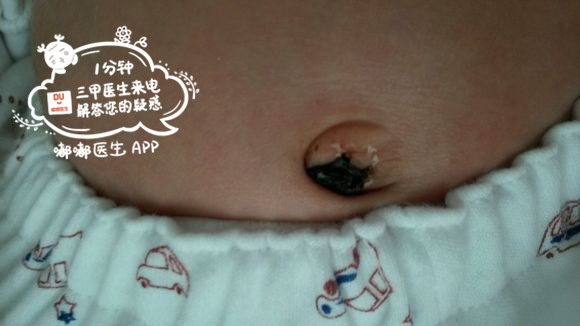 肚脐不能乱抠吗,宝宝总抠肚脐眼有什么小妙招