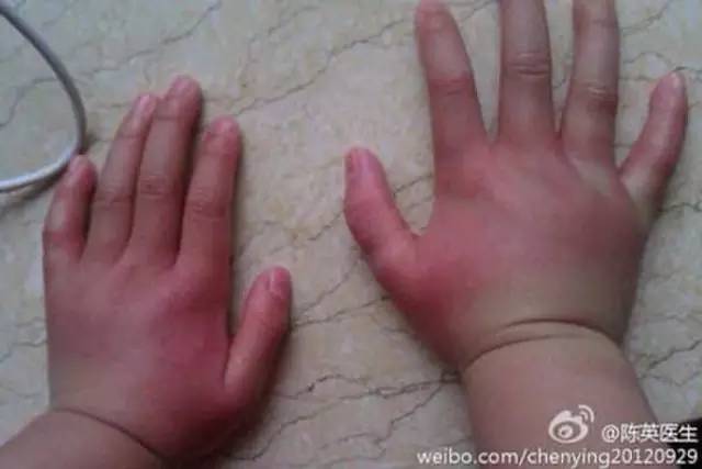 夏天来了怎么防蚊子叮咬,夏天来了什么方法驱赶蚊虫比较好