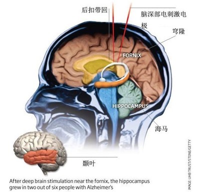帕金森线上义诊讲座,帕金森义诊小结