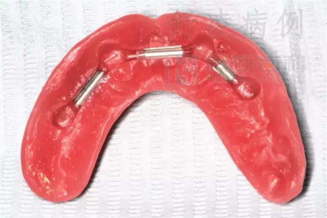 活动假牙戴不住，种植牙又嫌贵该怎么办？