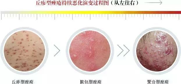 白头粉刺和炎症丘疹的区别,粉刺结节的最佳治疗方法