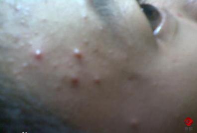 明明不是很油为什么长痘,下巴额头长痘是属于痘痘肌吗