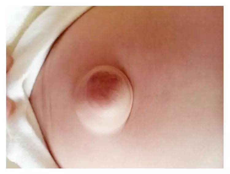宝宝肚脐处理视频,宝宝肚脐炎症怎么治疗