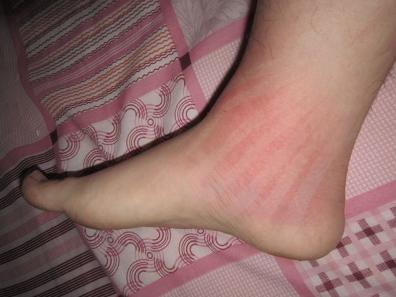 脚踝扭伤韧带拉伤恢复期间会疼吗,膝关节扭伤韧带轻度拉伤如何治疗