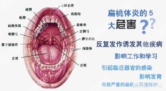 小儿扁桃体发炎什么引起的,小儿扁桃体频繁发炎什么原因