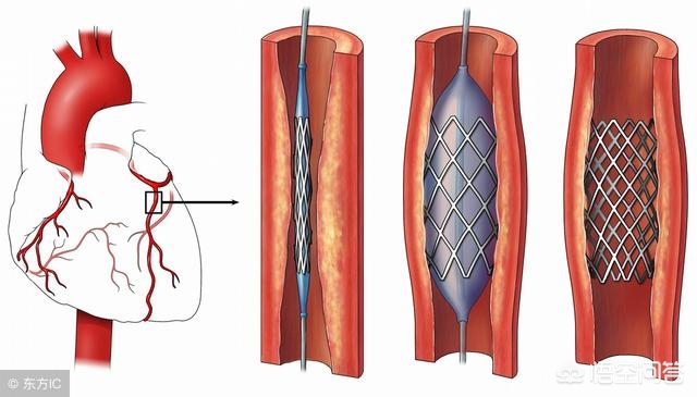 心脏血管堵塞有什么危险？怎样恢复正常？