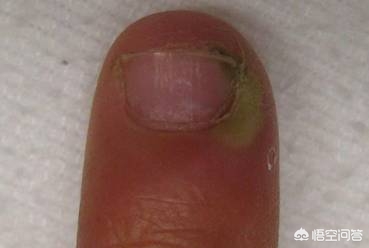 靶向治疗不良反应,靶向治疗也有很大的副作用吗