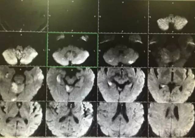 市人民医院取栓手术的全过程,病例分享视频素材
