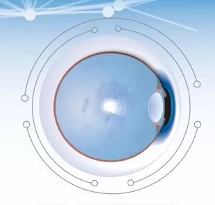 精准安全，无创无忧——UltraQReflex激光玻璃体消融术（LFR）